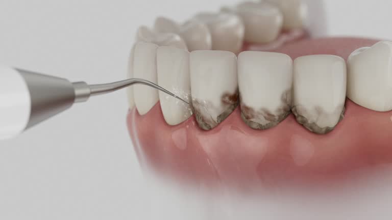 Trusted Wisdom Tooth Removal service in Burnt Mills, MD - Dentist Open Now